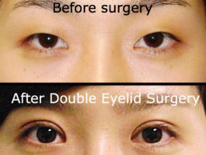 Before after picture of eyelid surgery